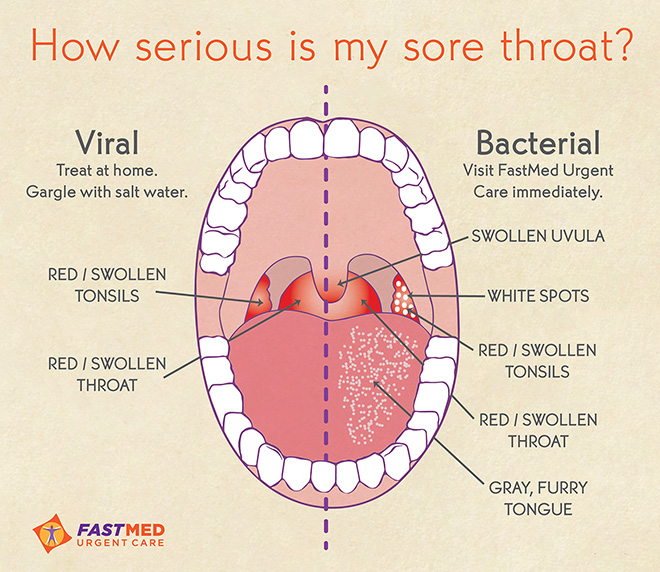 Sore Throat Strep Pharyngitis FastMed