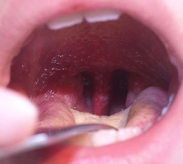 ulcer on tonsil