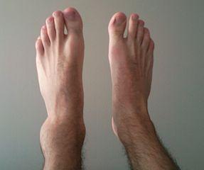 https://www.fastmed.com/wp-content/files/health-resources/related-searches/287px-Sprained_ankle_30min-process-s350x293.jpg