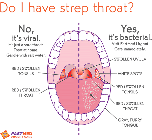 Strep Throat What It Looks Like FastMed