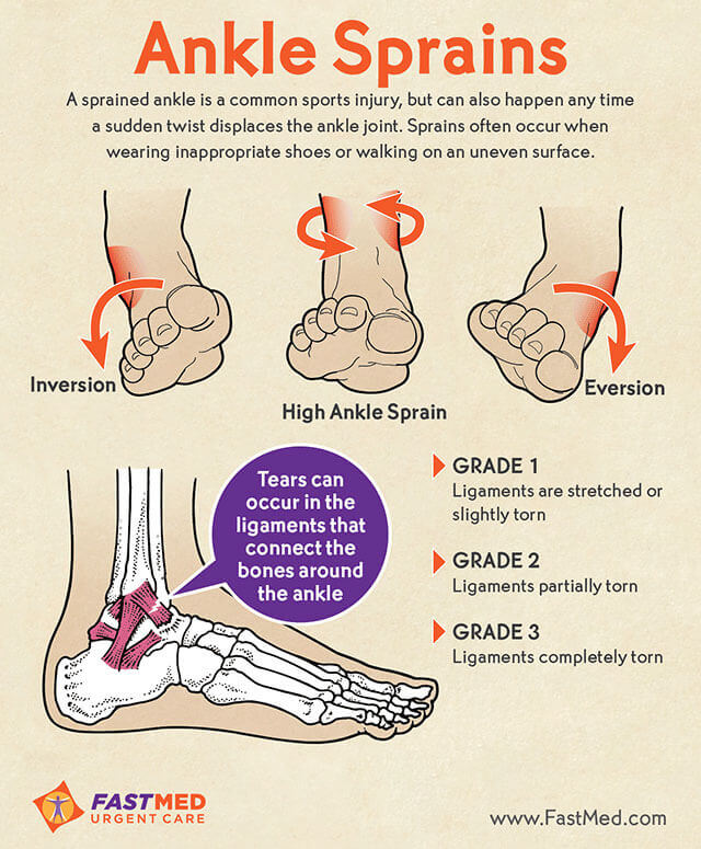 Do I Have A Sprained Ankle? [INFOGRAPHIC] - FastMed